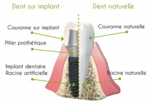 Implant dentaire et pose d'implant dentaire en Espagne. Oral Clinic vous accueille et vous guide pour la pose d'implant dentaire en Espagne