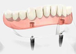 Prothèse Dentaire Sur Barre D'ackerman - prothèse dentaire amovible soutenue par une barre, vissée sur les implants, afin de rester fixe. En Espagne par Oral Clinic