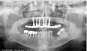 radiographie avant