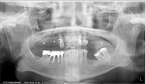 radiographie avant