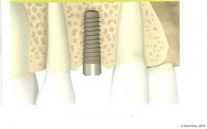 Implant-Dentaire-Pas-Cher-Espagne-Nos-Implants