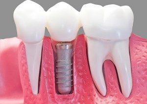 Oral Clinic vous offrent tous types d'implants dentaires selon cas