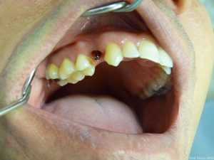 Couronne dentaire scéllée sur implant monobloc 1