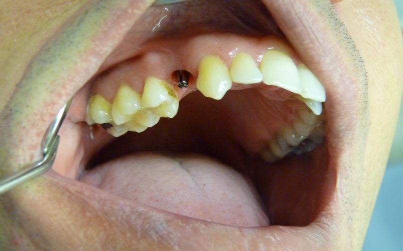 Couronne dentaire scéllée sur implant monobloc 1