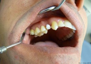 Couronne dentaire scéllée sur implant monobloc 3