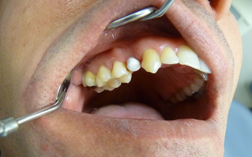 Couronne dentaire scéllée sur implant monobloc 3