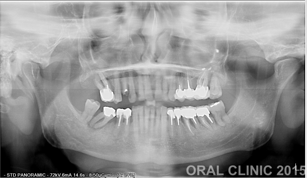 IMPLANTATION IMMEDIATE DEUX MOLAIRES 2