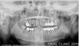 IMPLANTATION IMMEDIATE DEUX MOLAIRES 2