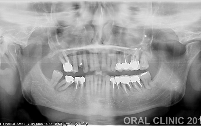 IMPLANTATION IMMEDIATE DEUX MOLAIRES 2