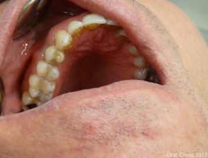 Couronne dentaire scéllée sur implant monobloc 4