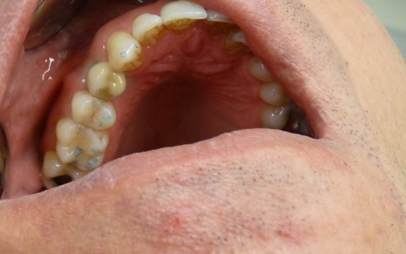 Couronne dentaire scéllée sur implant monobloc 4