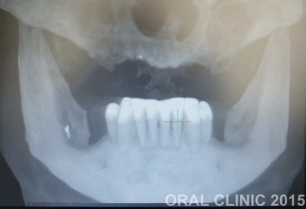 REHABILITATION MAXILLAIRE SUPERIEURE ET POSE BARRE CADCAM