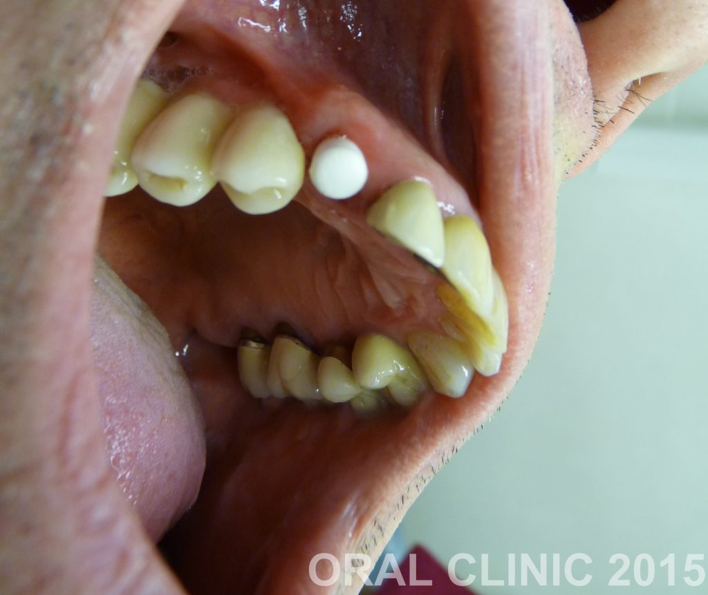 REMPLACEMENT D'UNE DENT POUR UN IMPLANT MONOBLOC