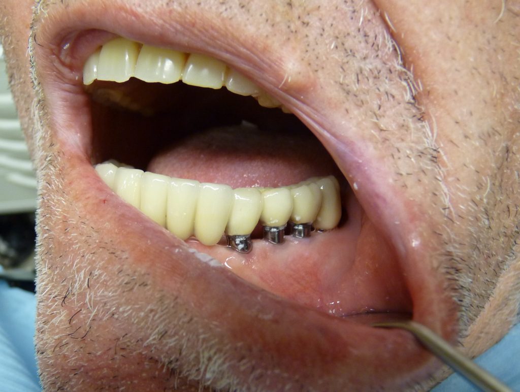 BRIDGE CERAMIQUE MIXTE DENTS NATURELLES ET IMPLANTS DENTAIRES