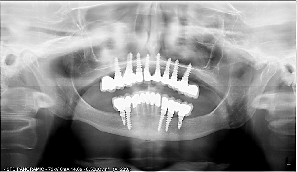 BRIDGE 12 COURONNES EN ZIRCONE SUR 8 IMPLANTS