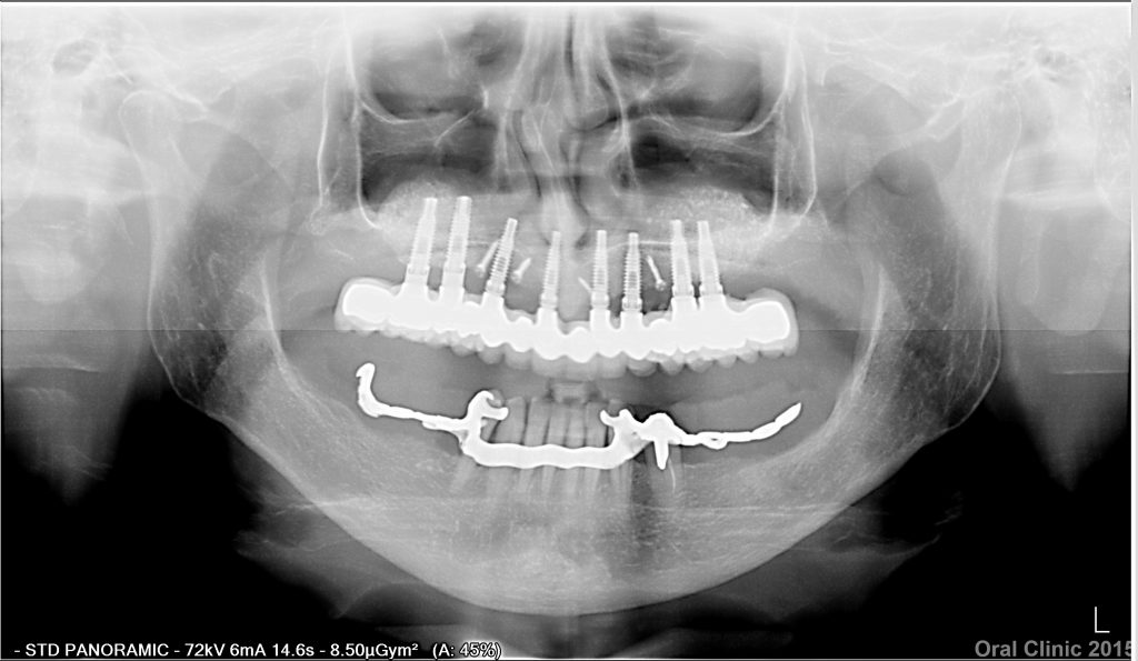POSE BRIDGE 12 DENTS SUR 8 IMPLANTS ET ELEVATION DU SINUS