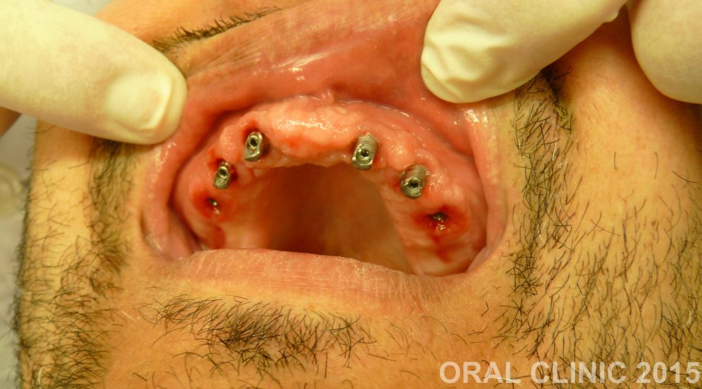 POSE PROTHESE HYBRIDE FIXE TRANSVISEE SUR 4 MOIGNONS ET 2 IMPLANTS