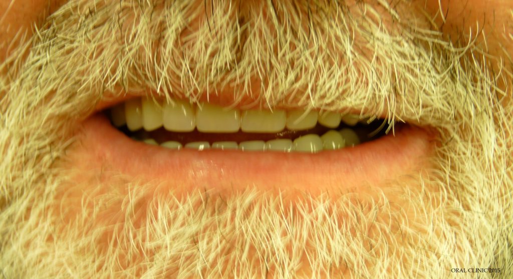 POSE D’UNE SUPRASTRUCTURE DE 12 DENTS PAR UNE BARRE SUR 4 IMPLANTS DENTAIRES