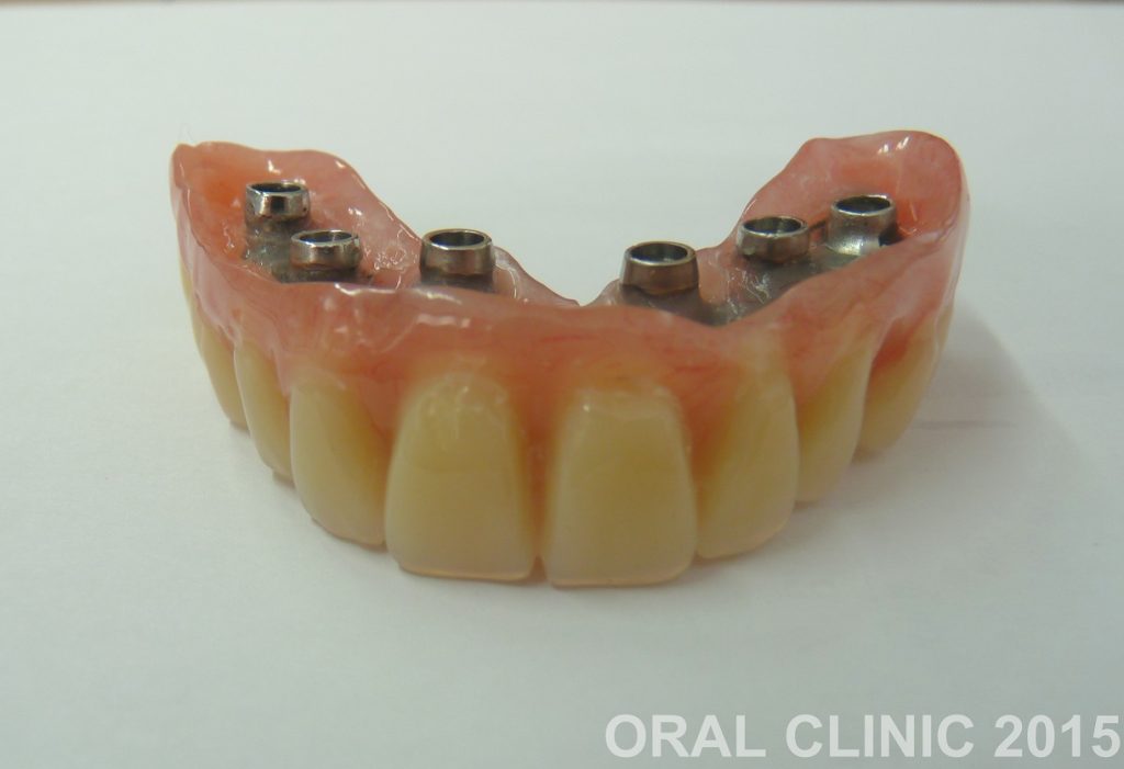 POSE 6 IMPLANTS DENTAIRES ET PROTHESE DENTAIRE HYBRIDE